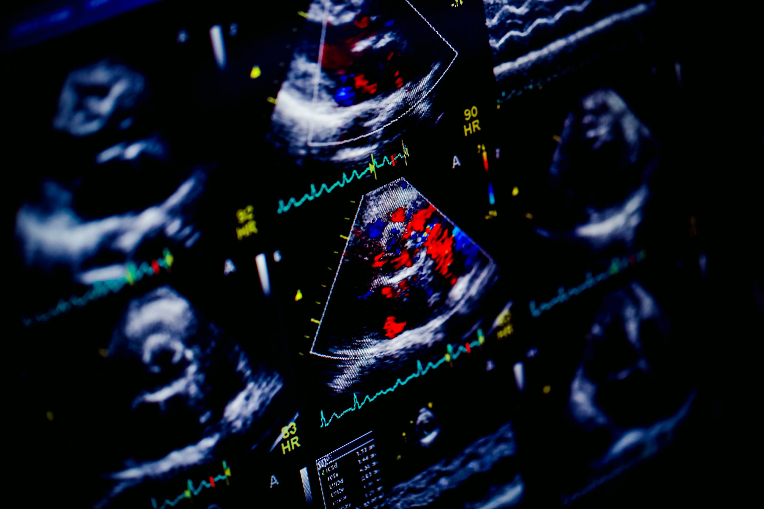 Echocardiography,(ultrasound),Machine